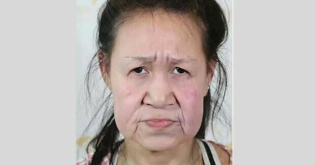 Patnáctiletá školačka s tváří babičky po plastice se stala kráskou