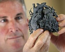 Lékaři vytiskli 3D srdce, aby zachránit čtyřleté dítě