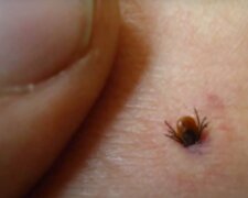 Jak správně vytáhnout klíště doma pinzetou: pět jednoduchých kroků