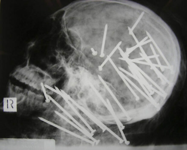 Nejpodivnější rentgenové snímky: Špendlík v ženském krku nebo hřebík v kostí prstu