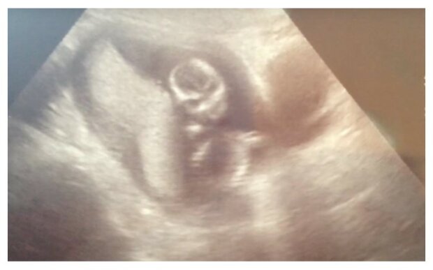 Těhotnou ženu velmi překvapil ultrazvuk. Vedle jejího dítěte byla démonická tvář