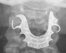 Chirurgové zapomněli na zubní protézu v krku dvaasedmdesátiletého Brita