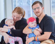 Lékaři rozdělili siamská dvojčata: jak dnes žijí holčičky