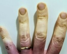 Nesnesitelnost zimy: Kvůli nemoci se vzhled ženy okamžitě změní, když je zima