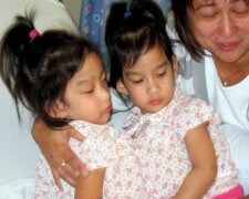 Sestry Sabukovi, siamská dvojčata, která byla úspěšně rozdělena