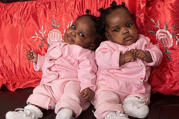 "Jsme velmi vděční chirurgům, kteří nám dali příležitost být dvěma oddělenými lidmi": Jak žijí siamská dvojčata, která přežila oddělení páteře